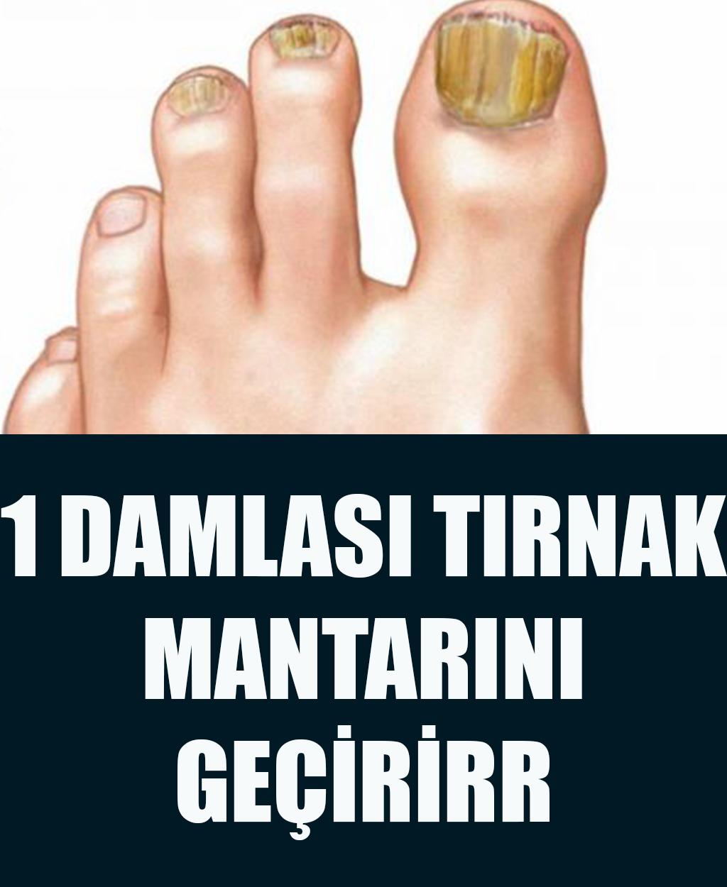 Basit Bir Yöntemle Tırnak Mantarından Kurtulun - 1