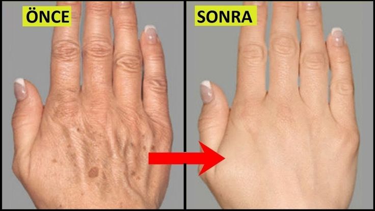 Ünlü Dermatoloji Uzmanın Tarifi İle Ciltteki Lekelerden Kurtulun - 3
