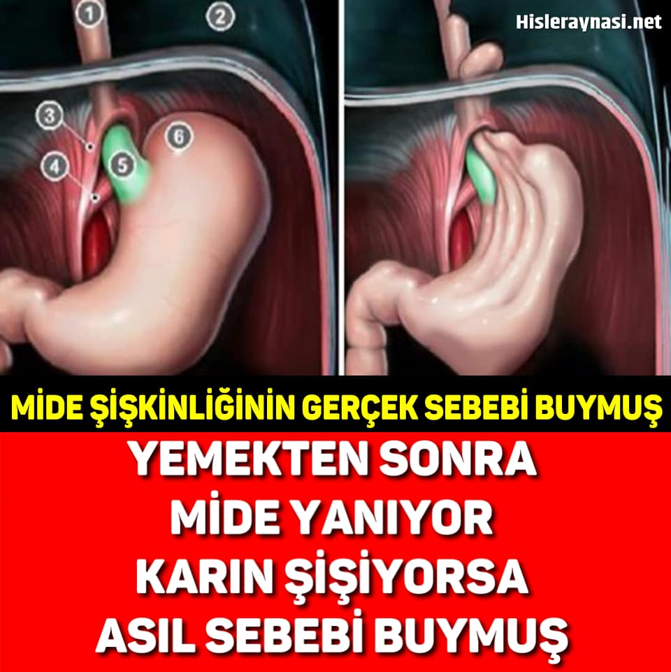 Yemekten Sonra Mide Şişiyorsa - 1