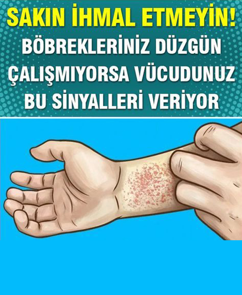 Böbreklerinizin Düzgün Çalışmadığını Gösteren Belirtiler	 - 1