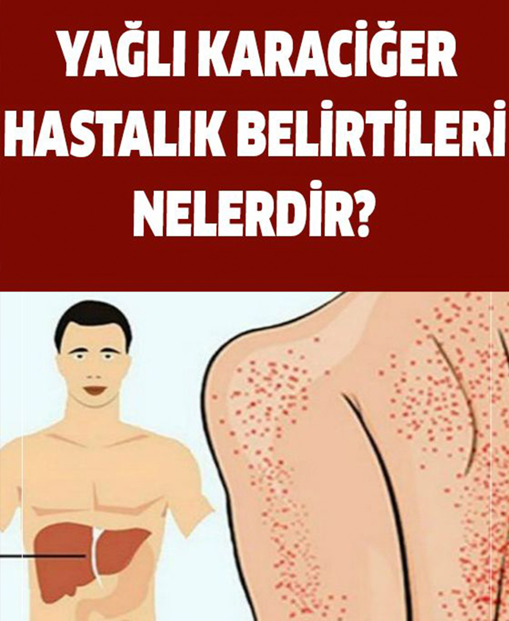 Yağlı Karaciğer Hastalığı Belirtileri - 1