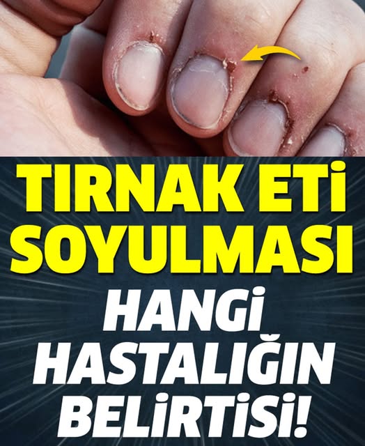 Tırnak Soyulması Hangi Hastalığın Belirtisi - 1