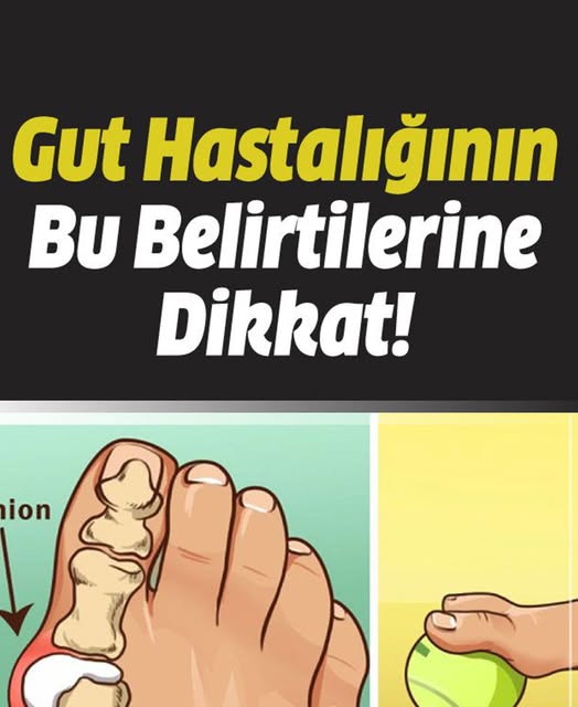 Gut Hastalığının Belirtilerine Dikkat - 1