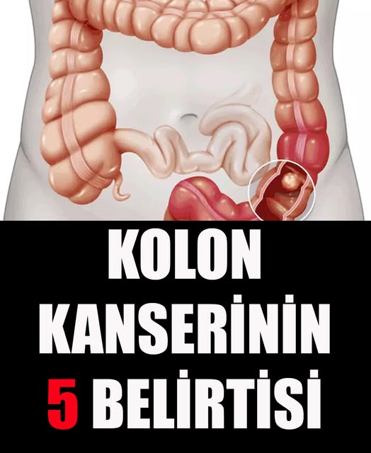 Kolon Kanserinin 5 Belirtisi	 - 1