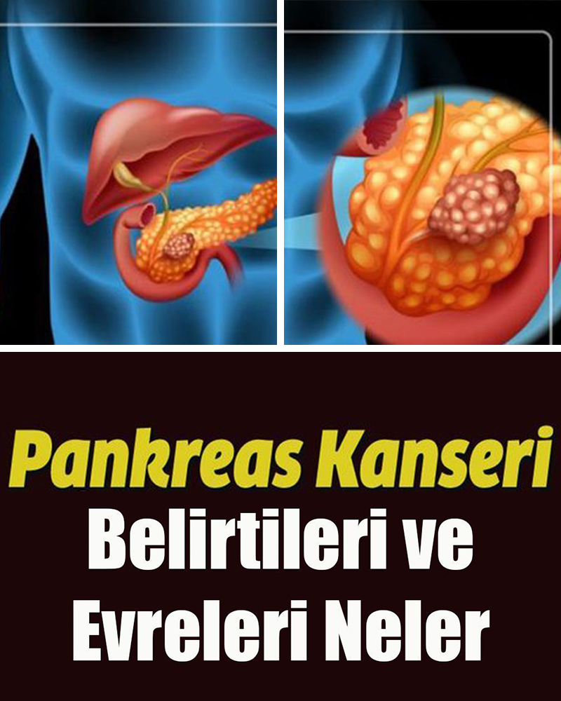 Pankreas Kanseri Belirtileri ve Evreleri Neler  - 1