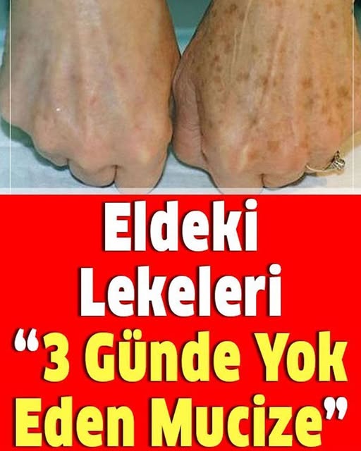 Eldeki lekeleri 3 günde yok eden mucize - 1