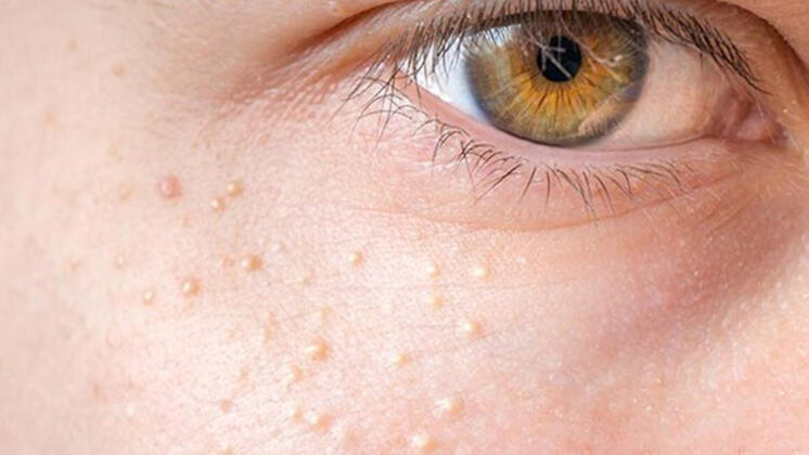 Yağ Bezelerini Geçirmenin En Etkili Yolları - 3