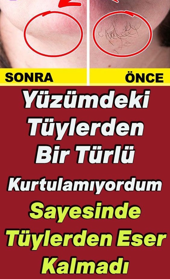 Evinizdeki Malzemelerle Yüz Tüylerinizden Kurtulun - 1