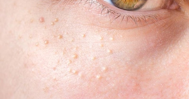 Yağ Bezelerini Geçirmenin En Etkili Yolları - 2