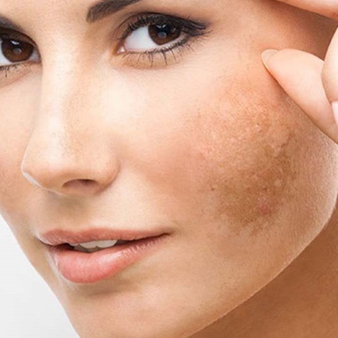 Ünlü Dermatoloji Uzmanın Tarifi İle Ciltteki Lekelerden Kurtulun - 2