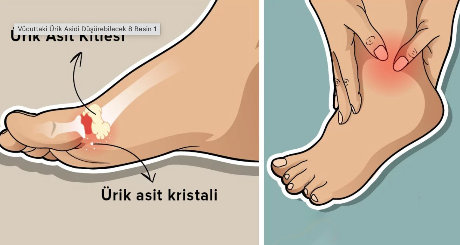 Ayaklardaki Ağrının Sebebi Ürik Asit Olabilir - 2