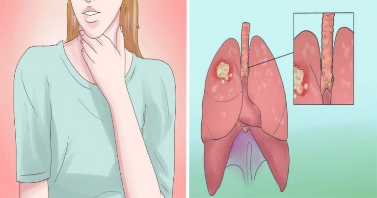 Çağın Hastalığı Akciğer Kanserinin Belirtileri - 3