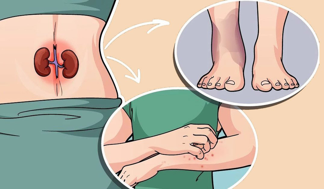 Böbrek Yetmezliğinin 10 Erken Belirtisi	 - 3