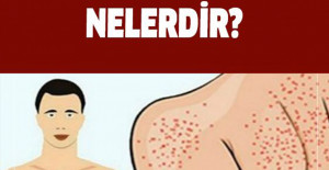 Yağlı Karaciğer Hastalığı Belirtileri