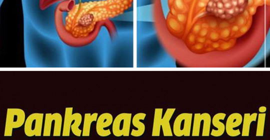 Pankreas Kanseri Belirtileri ve Evreleri Neler 
