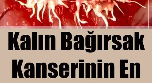 Kalın Bağırsak Kanserinin En Büyük Bulgusu 