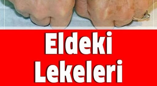 Eldeki lekeleri 3 günde yok eden mucize