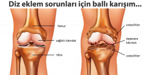 Diz Ağrılarınızı Bitiren Karışım