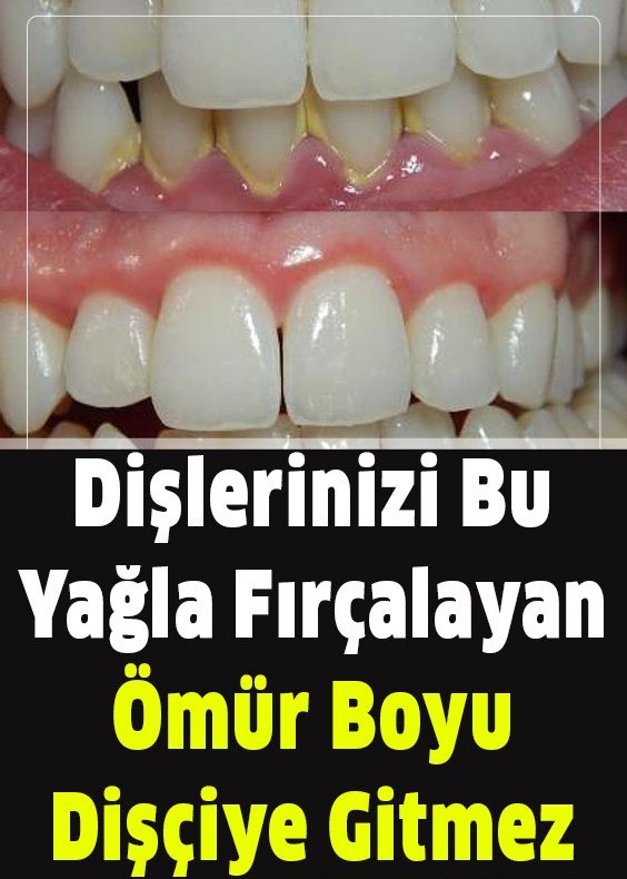 40 SENE DÜŞÜNSENİZ AKLINIZA BİLE GELMEZ DİŞTEKİ PLAĞI TARTARI YOK EDİYOR - 2