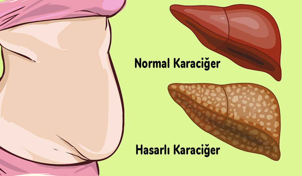 Karaciğerinizin Toksinlerle Dolu Olduğunun 6 Belirtisi - 2