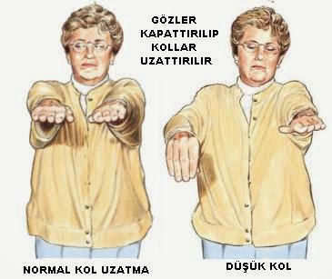 Felç geçirmeden evvel ortaya çıkan belirtiler - 3