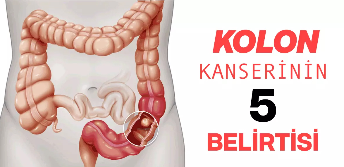 Kolon Kanserinin 5 Belirtisi	 - 2